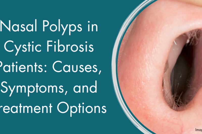 Nasal Polyps in Cystic Fibrosis Patients: Causes, Symptoms, and Treatment Options