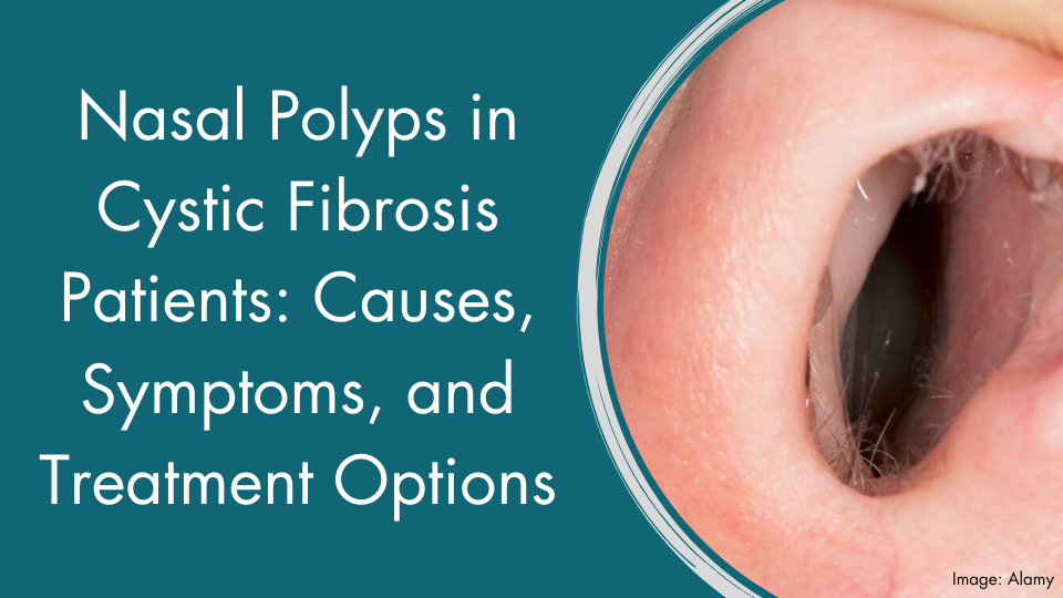 Nasal Polyps in Cystic Fibrosis Patients: Causes, Symptoms, and Treatment Options